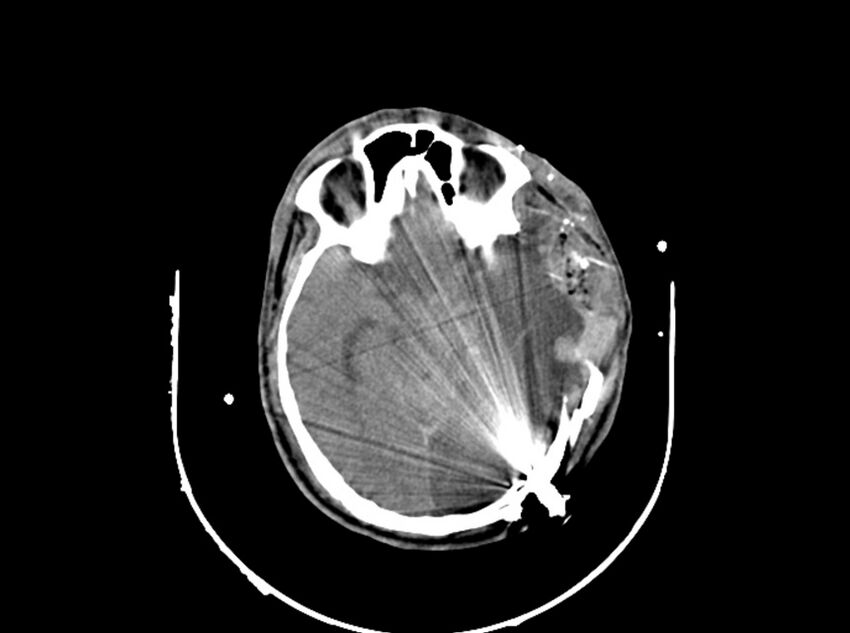 Brain injury by firearm projectile (Radiopaedia 82068-96087 B 92).jpg