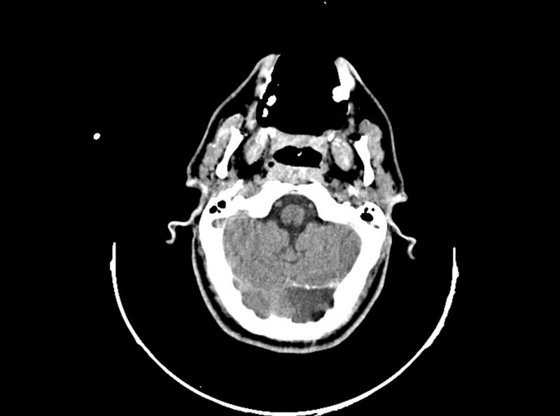 File:Brain injury by firearm projectile (Radiopaedia 82068-96088 A 69).jpg