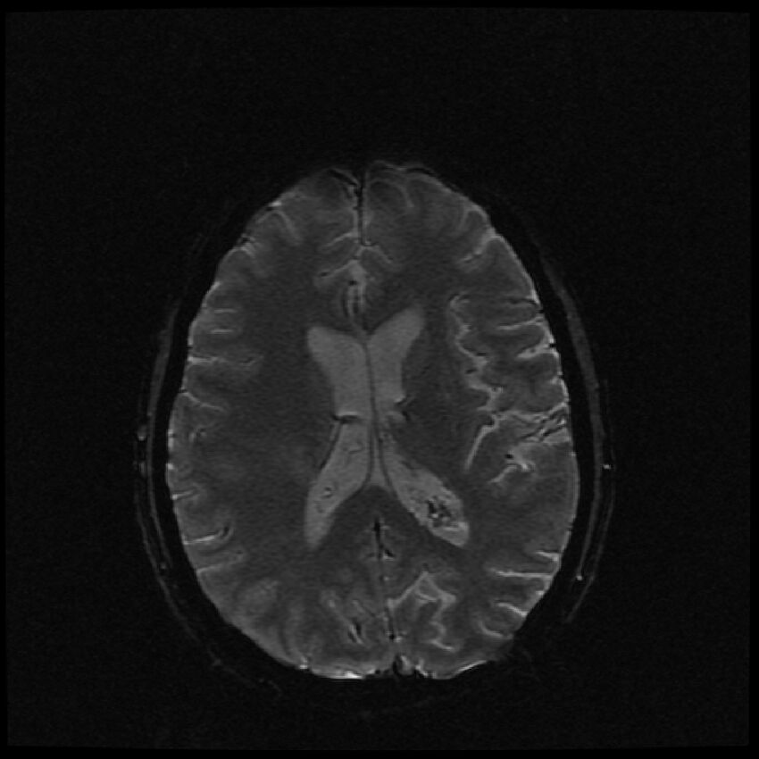 Brain metastases (renal cell carcinoma) (Radiopaedia 42571-45704 Axial SWI 24).jpg