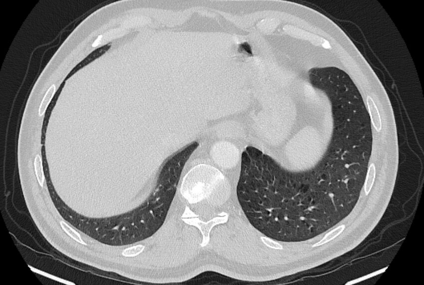 Brain metastases - lung cancer primary (Radiopaedia 75060-86116 Axial lung window 52).jpg