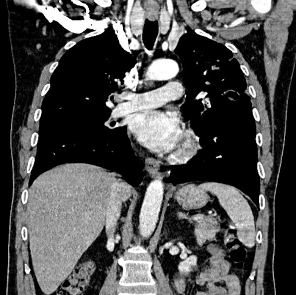 File:Brain metastases - lung cancer primary (Radiopaedia 75060-86116 C+ arterial phase 34).jpg
