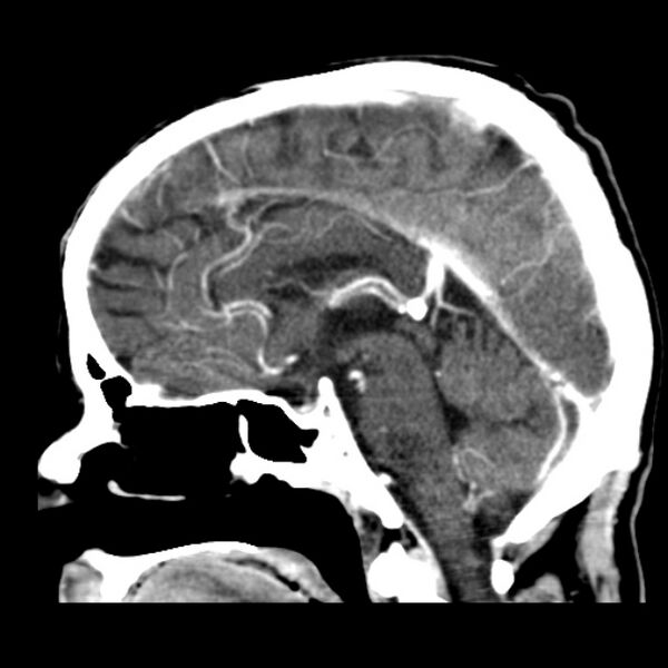 File:Brain metastases from lung cancer (Radiopaedia 24480-24781 C+ delayed 29).jpg
