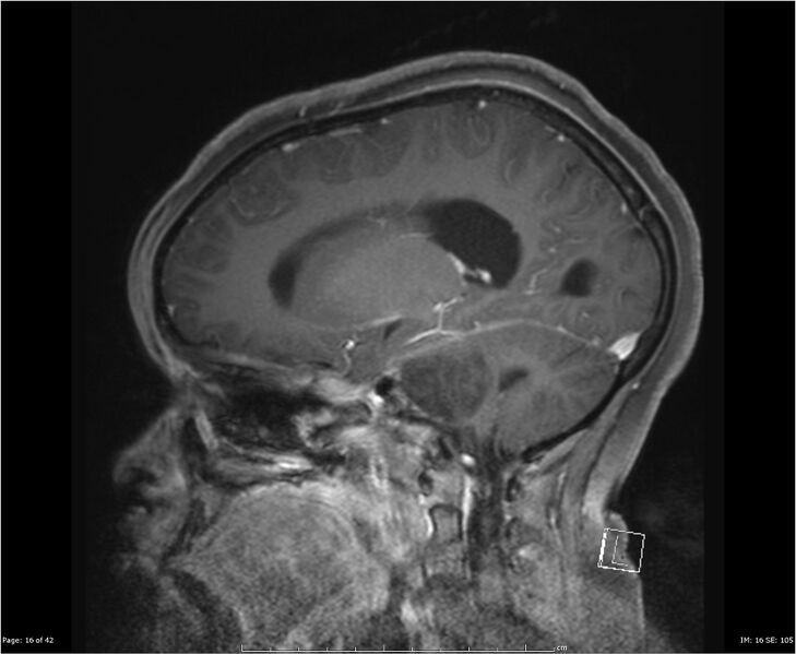 File:Brainstem glioma (Radiopaedia 21819-21775 D 16).jpg