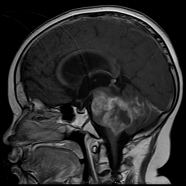 File:Brainstem glioma (Radiopaedia 6524-7839 Sagittal 1).jpg