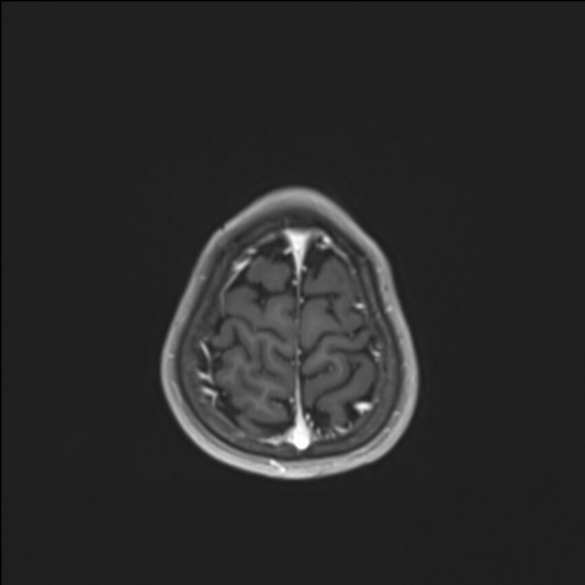 Brainstem glioma (Radiopaedia 70548-80674 Axial T1 C+ 140).jpg