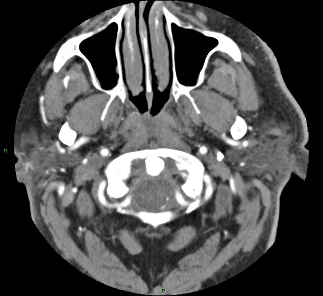 File:Brainstem hemorrhage (Radiopaedia 58794-66028 D 9).jpg