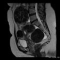 Broad ligament fibroid (Radiopaedia 49135-54241 Sagittal T2 13).jpg