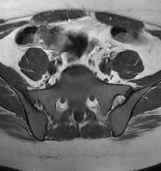 File:Broad ligament leiomyoma (Radiopaedia 81634-95516 Axial T1 2).jpg