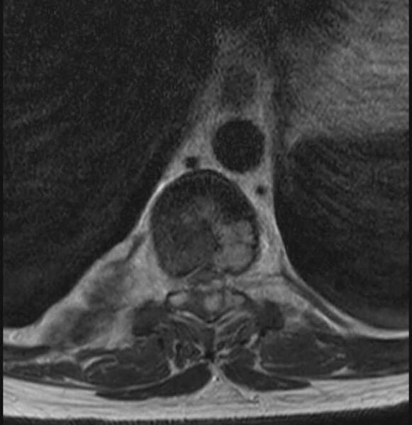 File:Brown tumors compressing the spinal cord (Radiopaedia 68442-78030 A 15).jpg