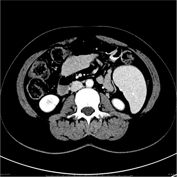 File:Budd-Chiari syndrome (Radiopaedia 27929-28177 Axial liver window 36).JPG