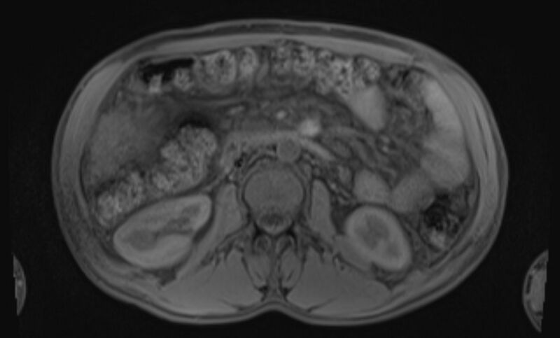 File:Budd Chiari syndrome (Radiopaedia 70299-80375 Axial T1 65).jpg