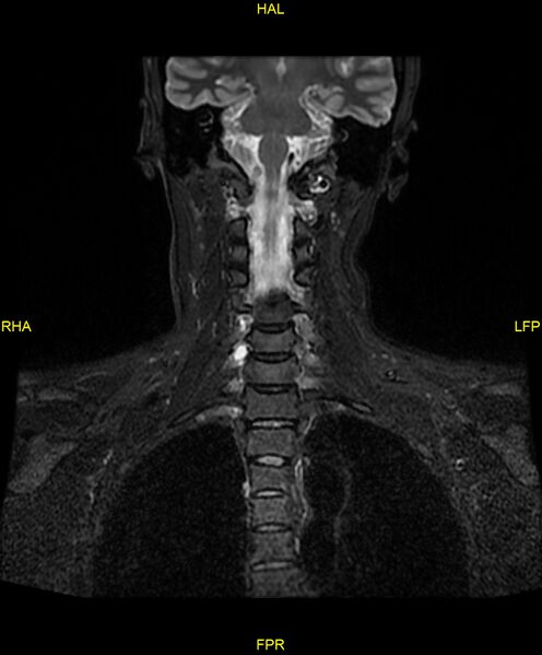 File:C5 nerve sheath tumor (Radiopaedia 85777-101596 Coronal T2 fat sat 12).jpg