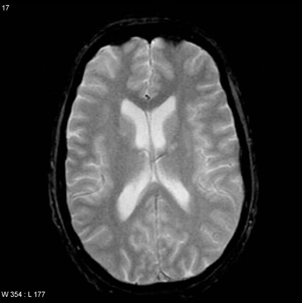File:CMV ventriculitis and encephalitis (Radiopaedia 5416-7166 Axial Gradient Echo 4).jpg