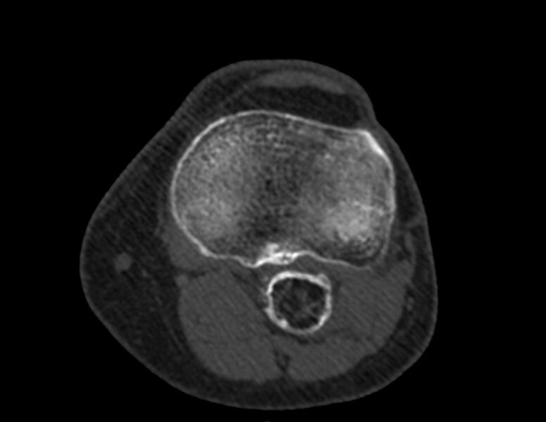 File:Calcified hematoma - popliteal fossa (Radiopaedia 63938-72763 Axial bone window 44).jpg
