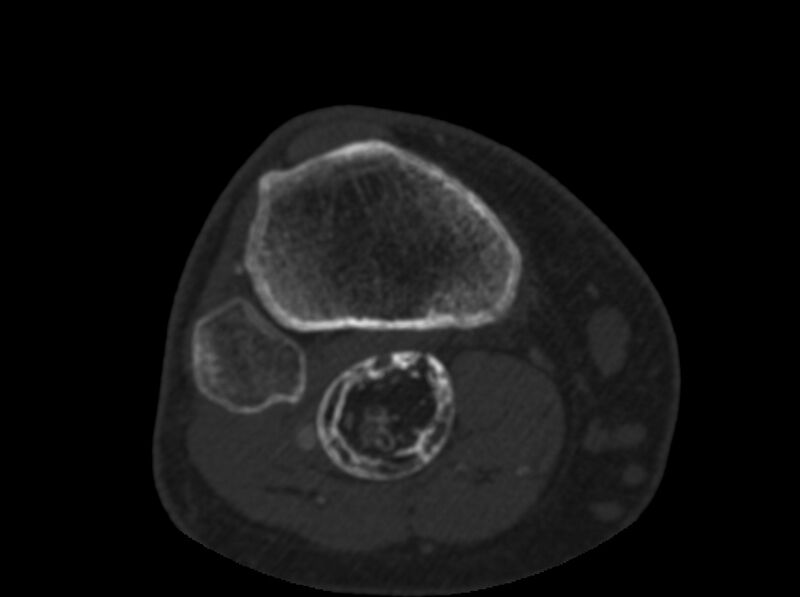 File:Calcified hematoma - popliteal fossa (Radiopaedia 63938-72763 C 68).jpg