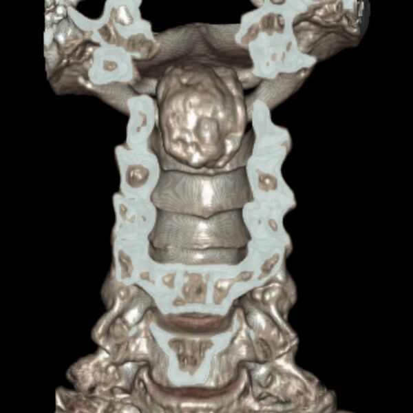 File:Calcified meningioma - cervical canal (Radiopaedia 70136-80171 3D-VR 3).jpg
