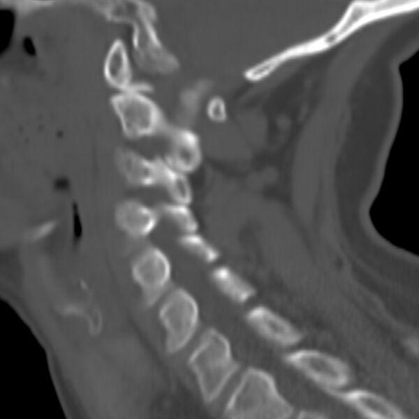 File:Calcified meningioma - cervical canal (Radiopaedia 70136-80171 Sagittal bone window 8).jpg