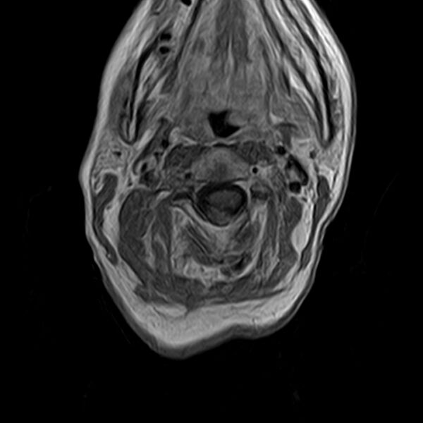 File:Calcified meningioma - cervical canal (Radiopaedia 70136-82468 Axial T1 C+ 13).jpg