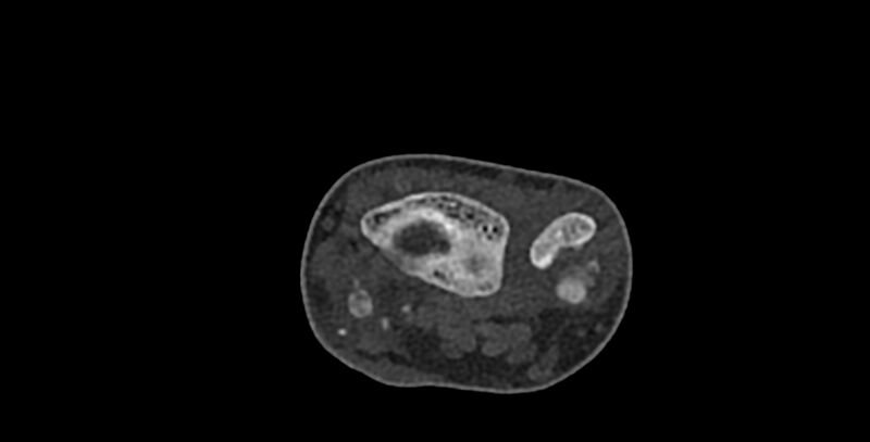 File:Calcifying aponeurotic fibroma (Radiopaedia 88423-105064 Axial bone window 37).jpg