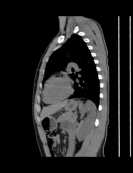 File:Calcifying pulmonary metastases (Radiopaedia 33359-34396 C 24).jpg