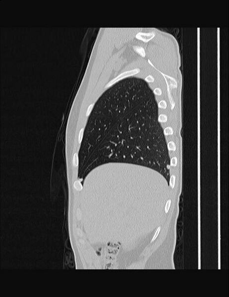 File:Calcifying pulmonary metastases (Radiopaedia 33359-34396 Sagittal lung window 59).jpg