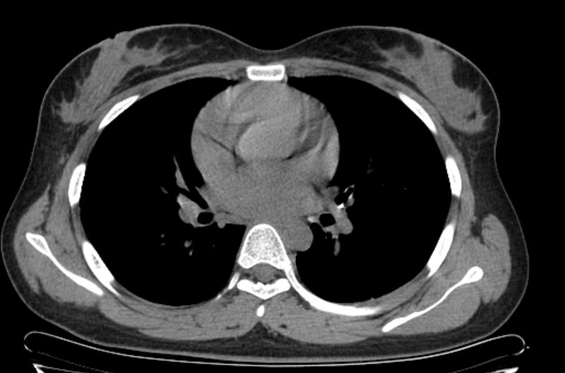 File:Cannonball metastases - uterine choriocarcinoma (Radiopaedia 70137-80173 Axial non-contrast 57).jpg