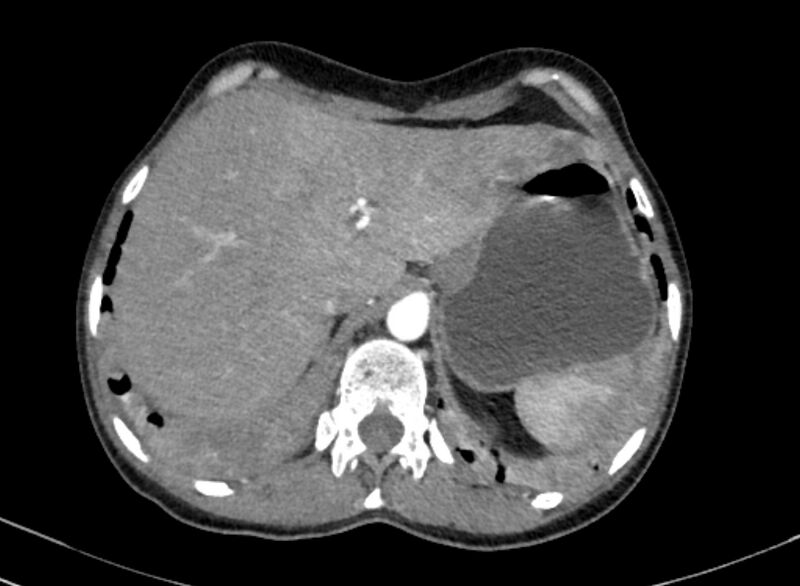 File:Cannonball metastases from breast cancer (Radiopaedia 91024-108569 A 111).jpg