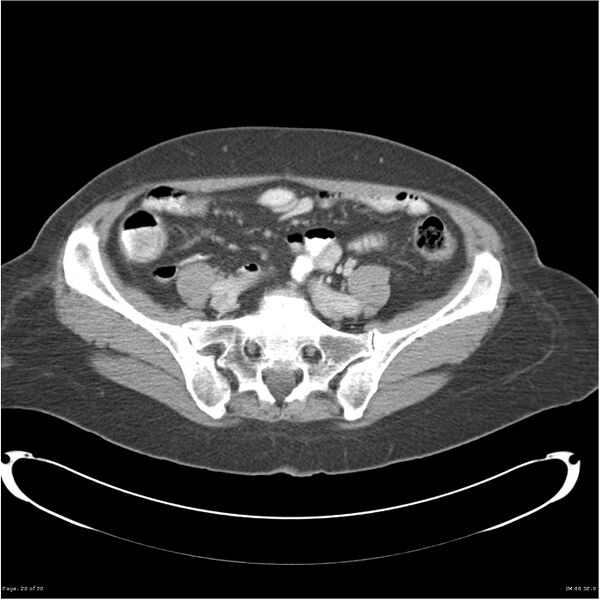 File:Carcinoid tumor of the ileum with metastasis to orbit (Radiopaedia 28165-28425 A 20).jpg