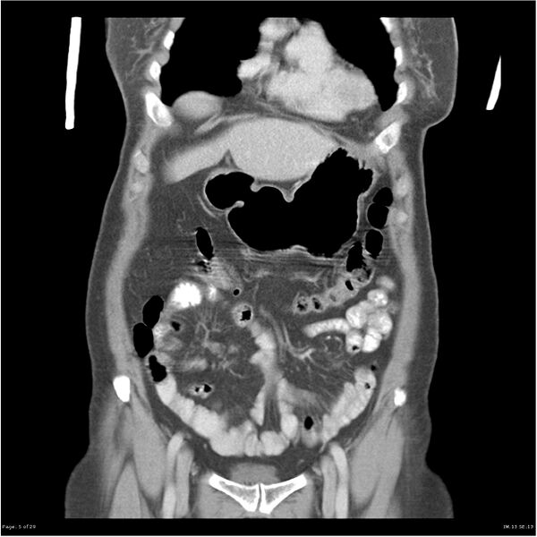 File:Carcinoid tumor of the ileum with metastasis to orbit (Radiopaedia 28165-28425 B 5).jpg