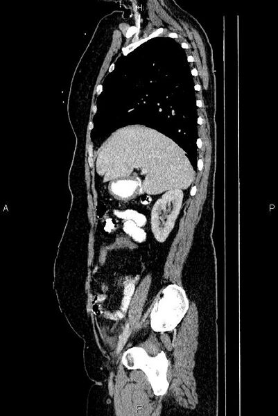 File:Carcinoma of uterine cervix (Radiopaedia 85861-101700 D 22).jpg