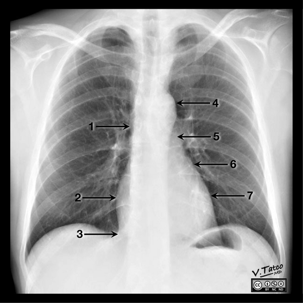 File:Cardiomediastinal anatomy on chest radiography (annotated images) (Radiopaedia 46331-50743 Frontal 1).png