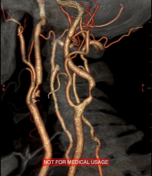 File:Carotid artery stenosis (Radiopaedia 28786-29086 A 4).jpg