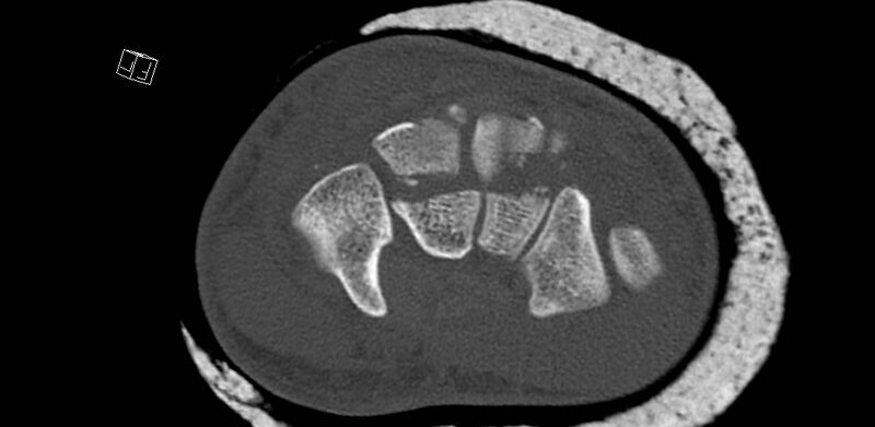 File:Carpal fractures (smart watch impaction) (Radiopaedia 55844-62430 Axial bone window 38).jpg