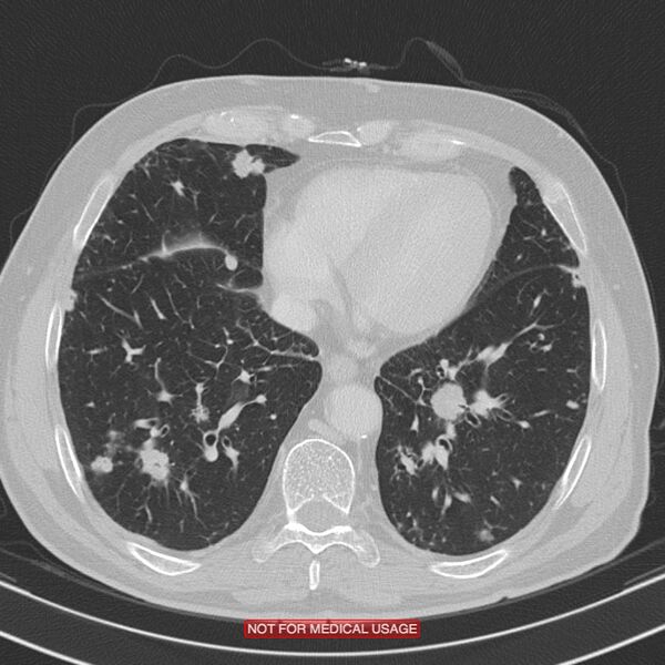 File:Cavitating pulmonary metastases (Radiopaedia 24920-25184 Axial lung window 17).jpg