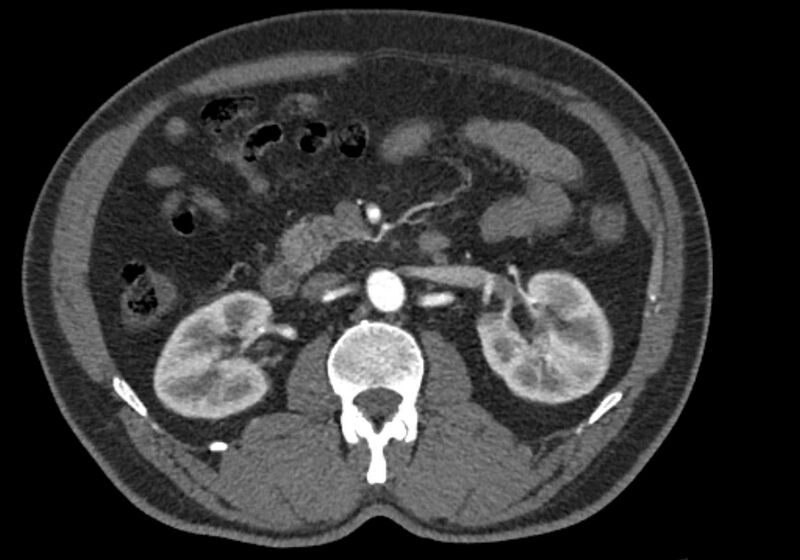 File:Celiac artery dissection (Radiopaedia 52194-58080 A 44).jpg