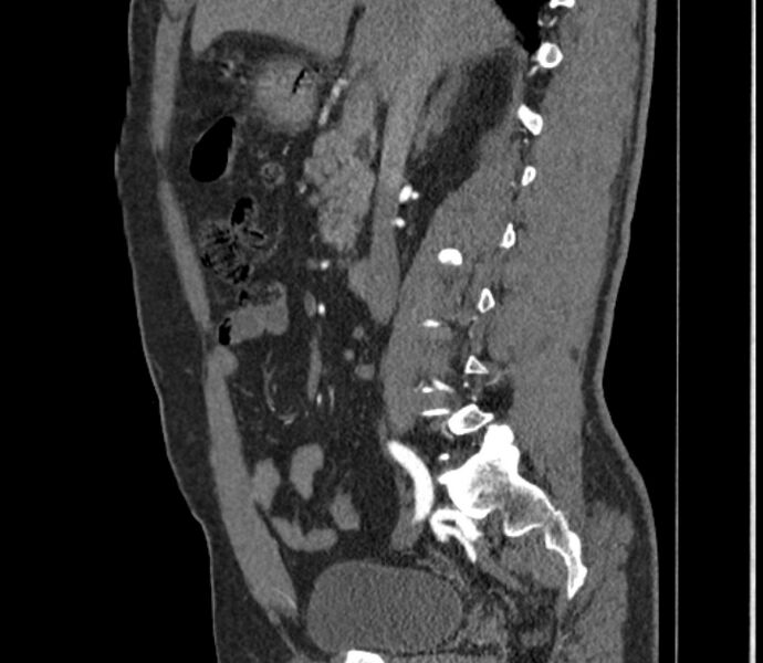 File:Celiac artery dissection (Radiopaedia 52194-58080 B 17).jpg