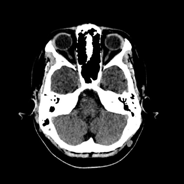 File:Central nervous system Langerhans cell histiocytosis (Radiopaedia 65728-74878 Axial non-contrast 14).jpg
