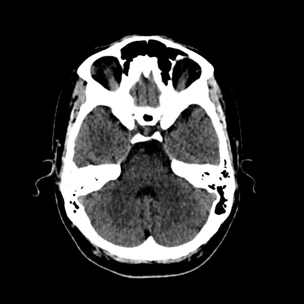 File:Central nervous system Langerhans cell histiocytosis (Radiopaedia 65728-74878 Axial non-contrast 17).jpg