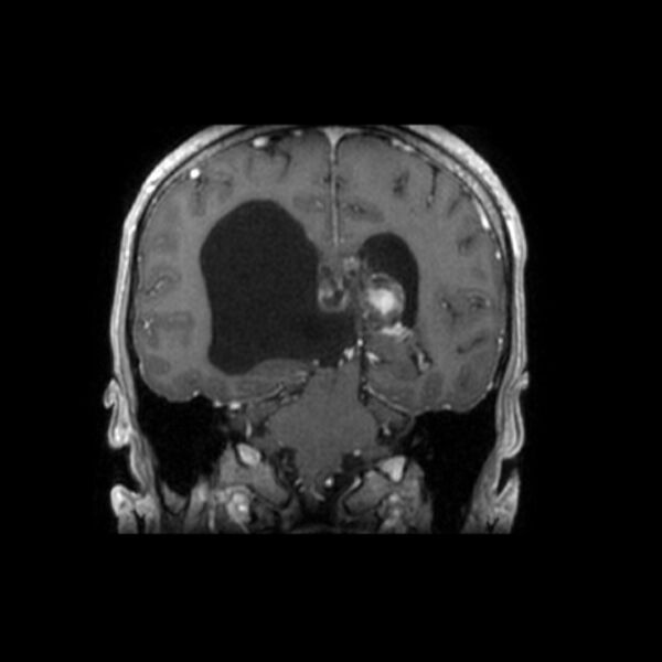 File:Central neurocytoma (Radiopaedia 67618-77021 Coronal T1 C+ 12).jpg