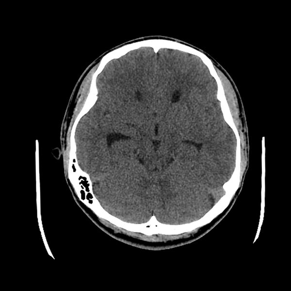 File:Central neurocytoma (Radiopaedia 79320-92379 Axial non-contrast 19).jpg