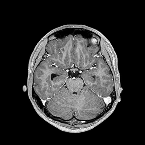 File:Central neurocytoma (Radiopaedia 79320-92380 Axial T1 C+ 96).jpg