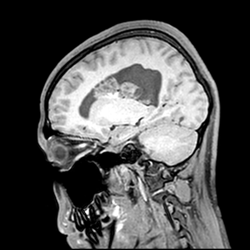 Central neurocytoma (Radiopaedia 79320-92380 Sagittal T1 165).jpg