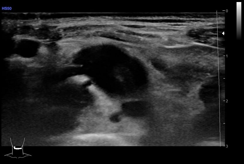 Central venous catheter-related thrombosis (Radiopaedia 61135-69025 Transverse 14).jpg
