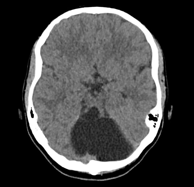 File:Cerebellar agenesis (Radiopaedia 30203-30817 Axial non-contrast 16).jpg