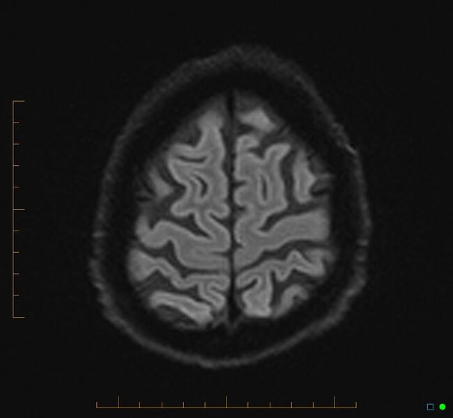 File:Cerebellar gangliocytoma (Radiopaedia 65377-74422 Axial DWI 35).jpg