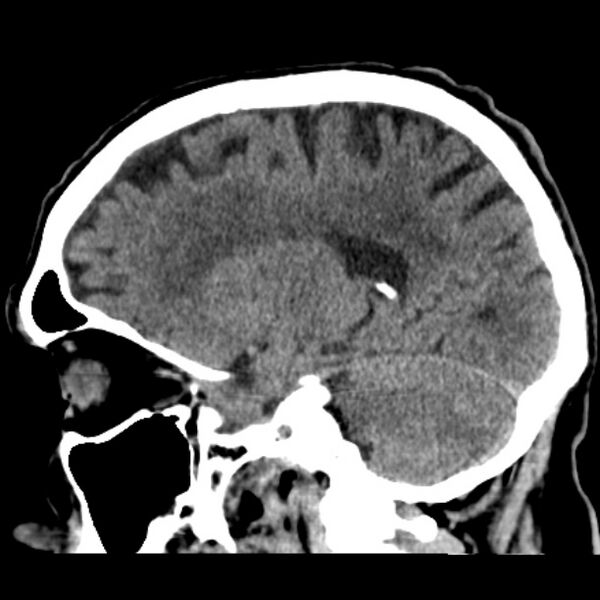 File:Cerebellar hemorrhage (Radiopaedia 27193-27359 C 17).jpg