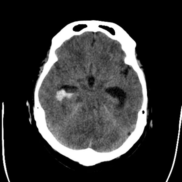 File:Cerebellar hemorrhage causing obstructive hydrocephalus (Radiopaedia 33989-35207 Axial non-contrast 18).jpg