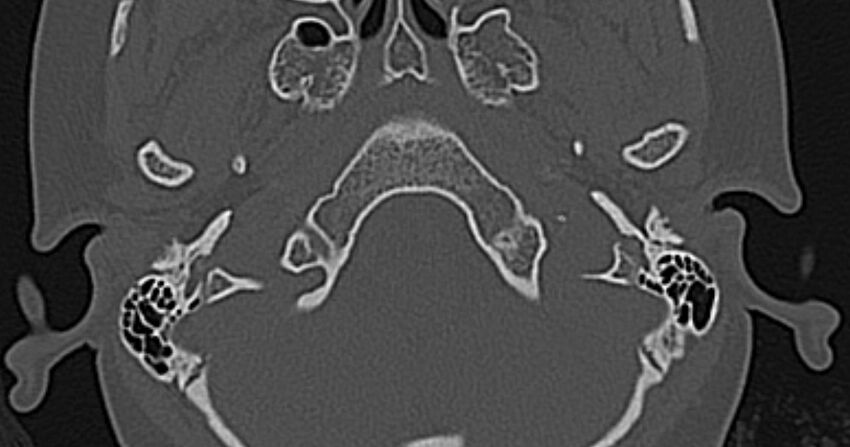 Cerebellopontine angle lipoma (Radiopaedia 57303-64242 Axial bone window 4).jpg