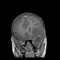 Cerebral abscess post cardiac surgery (Radiopaedia 27244-27420 Coronal T1 C+ 5).jpg