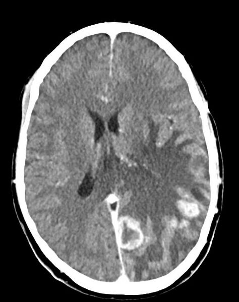 File:Cerebral abscesses (Radiopaedia 70458-80568 Axial Contrast 36).jpg